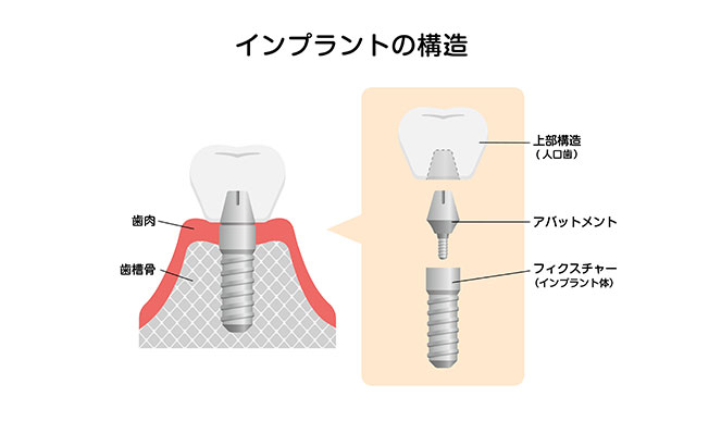 インプラントの構造